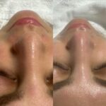 Vorher-nachher Hautbild im Gesicht: sichtbar verfeinert und gleichmäßiger nach der Behandlung